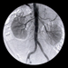 Nefrit - Glomerulonefrit